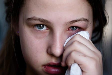 a girl's eye is swollen with pinkeye